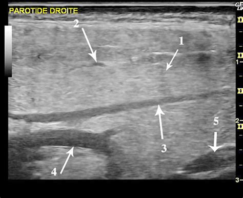 Parotid Gland Ultrasound Measurement