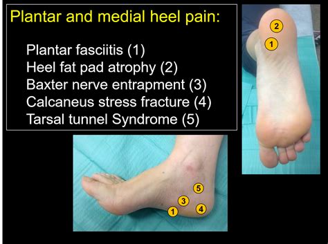 Heel Fat Pad Syndrome Causes, Symptoms, Diagnosis Treatment | atelier-yuwa.ciao.jp