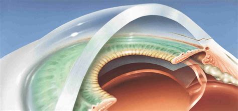 Premium Lens Implants Surgery, Shrewsbury