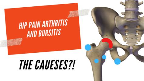 Hip pain Arthritis / Bursitis - AW BOON WEI