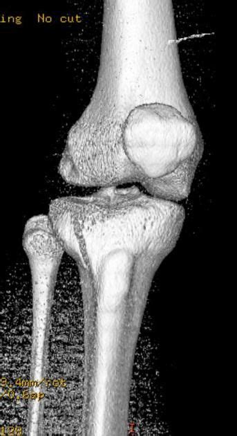 Schatzker classification | Radiology Reference Article | Radiopaedia ...