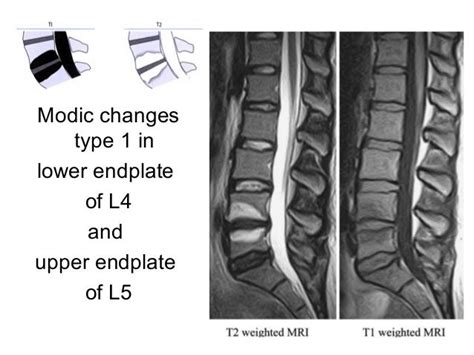 Modic Type 1 Symptoms