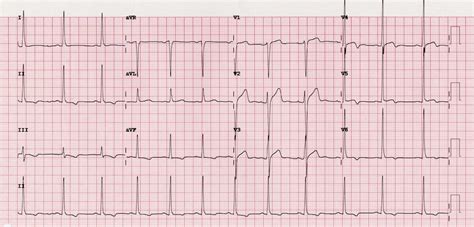 Wellens Syndrome • LITFL • ECG Library Eponym