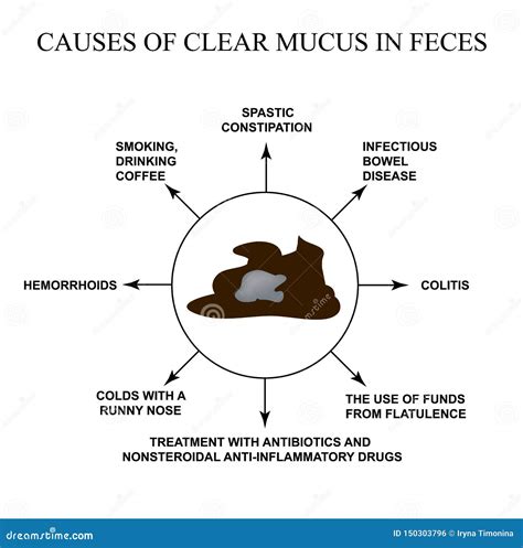 Causes of Clear Mucus in the Feces. Diseases of the Gastrointestinal ...