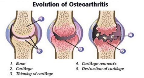 The Basics of Degenerative Joint Disease - LubriSynHA