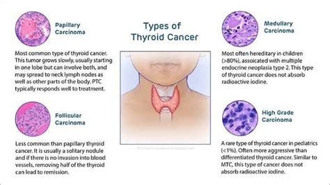 Types of thyroid cancer - MEDizzy