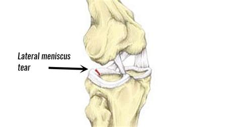 Lateral Meniscus Tear - Symptoms, Causes, Treatment & Rehabilitation