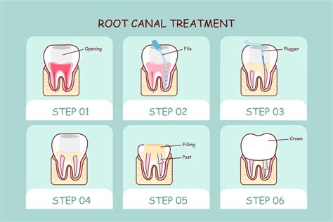 Recovery After Root Canal Treatment | Pure NZ Dental