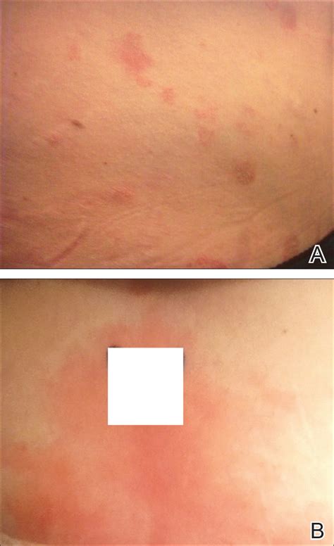 Autoimmune Progesterone Dermatitis | MDedge Dermatology