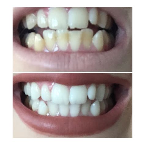 My Teeth Whitening Transformation - Before & After - Sleek-chic