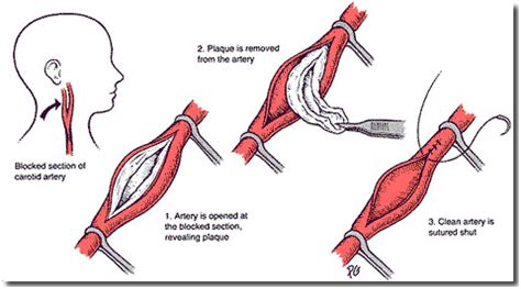 What Is a Vascular Surgery? - Life Health Max