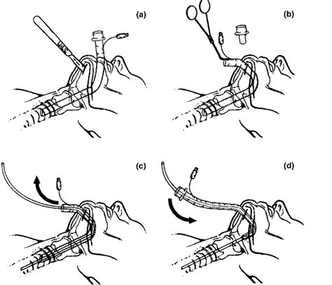 Schematic diagram showing submental intubation procedure using a tube... | Download Scientific ...