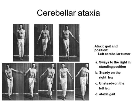 Cerebeller Ataxia : Cause,Symptom's,Diagnosis, Physiotherapy Treatment