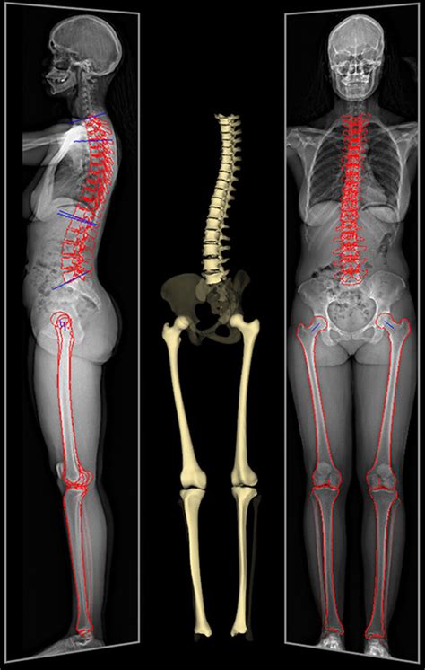 EOS is a low-dose radiation alternative to X-rays and CT