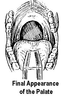 Uvulopalatopharyngoplasty - wikidoc