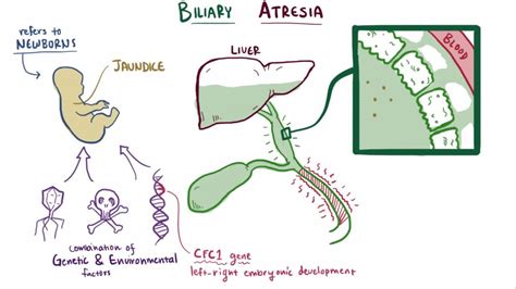 Biliary Atresia condition Symptoms and Treatment, cost of Biliary ...