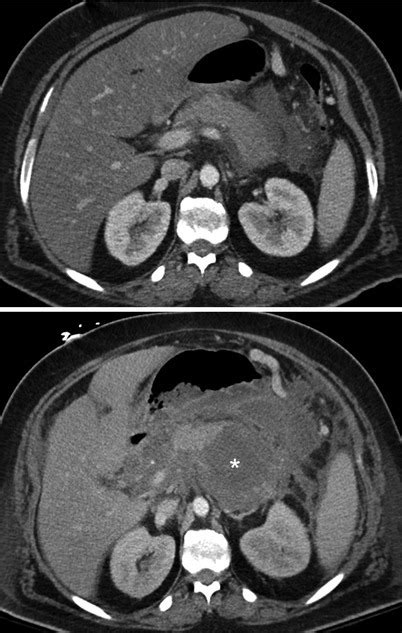 Fig. 13.15, [Evolution of acute interstitial edematous...]. - Diseases of the Abdomen and Pelvis ...