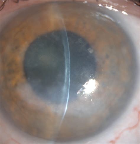 Posterior polymorphous corneal dystrophy: for professionals - Gene Vision