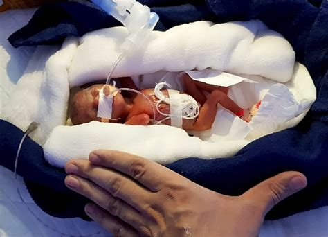 Meet One Of The World's Smallest Babies Ever To Survive - Born At 0 ...