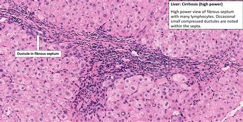 Cirrhosis Histology