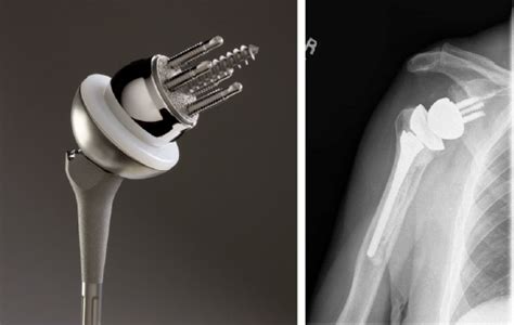 Shoulder arthritis: Reverse total shoulder | UW Orthopaedics and Sports ...