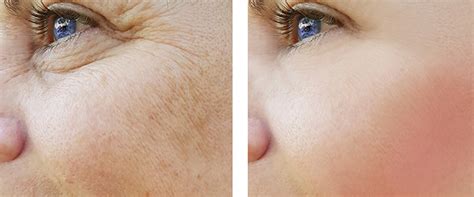 9 Skin Rejuvenation Treatments That Can Make You Look Younger – SkinKraft