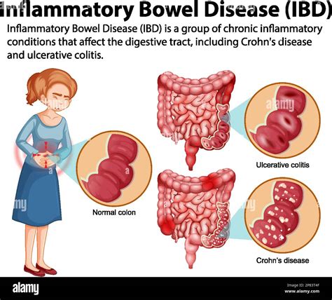 Inflammatory Bowel Disease Wikipedia