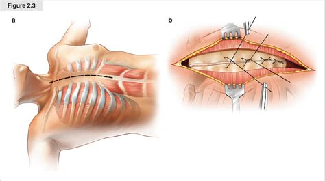 Thoracotomy and Sternotomy | SpringerLink