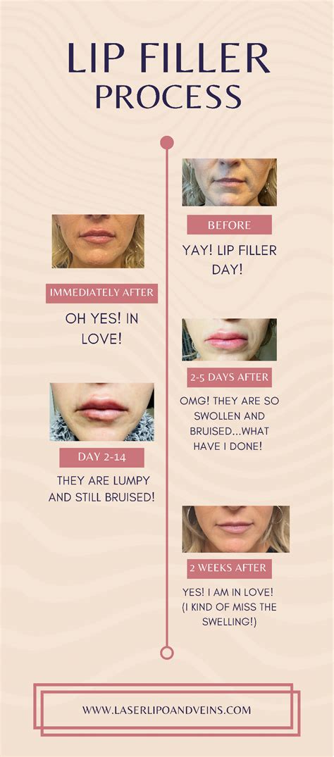 Learn What Type of Lip Fillers are Best for You | Laser Lipo and Veins