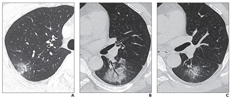 Case: Myalgia, Air Bronchogram Sign, Lesions