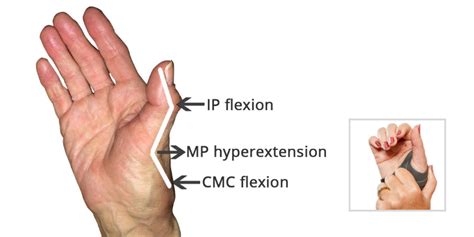 How to Manage a Thumb Deformity from Rheumatoid Arthritis