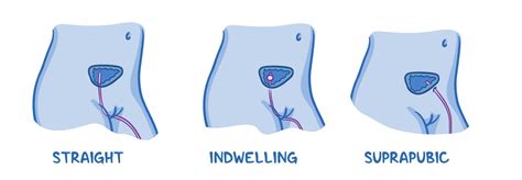 Use Of Indwelling Catheters