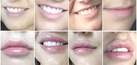 My before and after lip filler pictures Read all about it: www ...