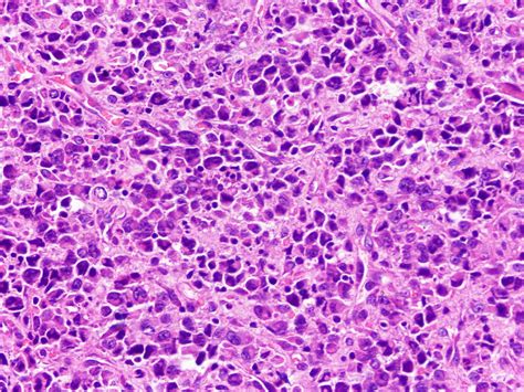 Image_26 | Anaplastic large cell lymphoma, ALK negative: 23 … | Flickr