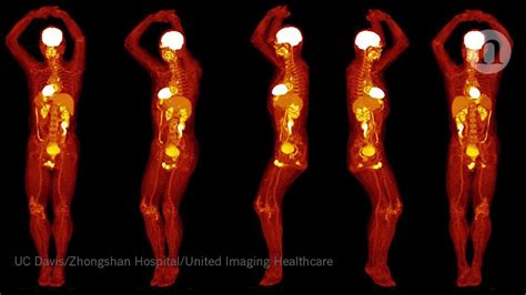 Whole-body PET scanner produces 3D images in seconds: « The modified ...