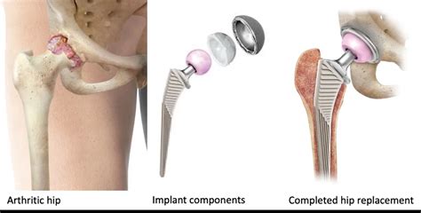 Hip Replacement Preparation: 4 Tests Are Done Before Surgery - Elder VIP