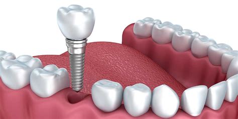 Risks of Dental Implants