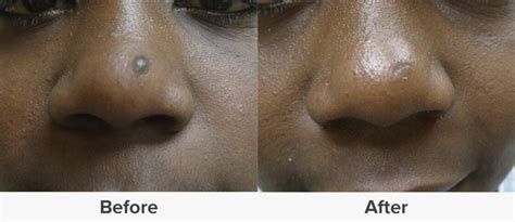 Mole removal scar: Healing and treatments