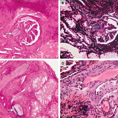 Kidney-Biopsy Results. A percutaneous kidney biopsy revealed... | Download Scientific Diagram