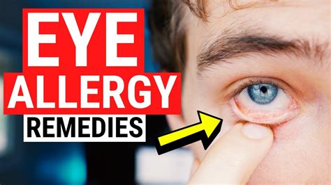 Eye Allergy Remedies - Tips for Itchy and Watery Eyes - YouTube