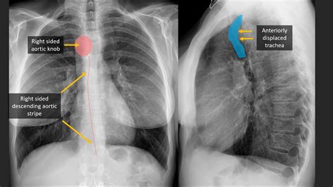 Cardiovascular Findings on Chest Radiography with CT and MRI correlation - YouTube