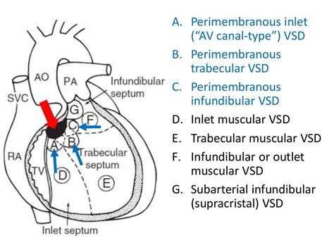 Ventricular Septal Defect