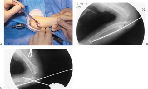 Congenital Radioulnar Synostosis | Musculoskeletal Key