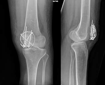 Patella Fracture X Ray