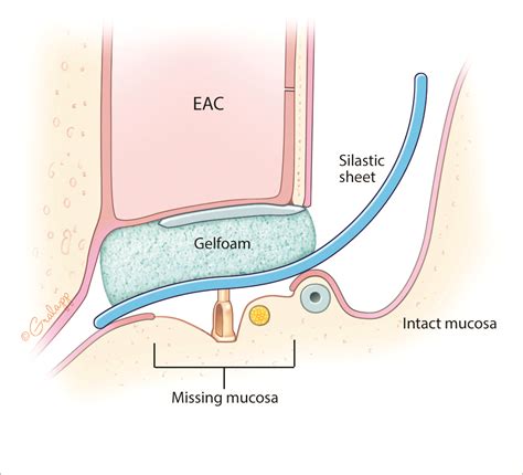 Staging Ossiculoplasty – Oto Surgery Atlas