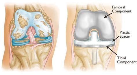 Total Knee Replacement - OrthoInfo - AAOS