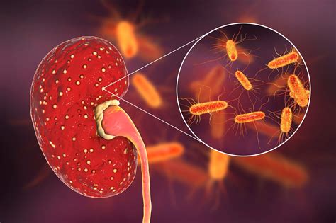 Pyelonephritis: Causes, Symptoms & Treatment