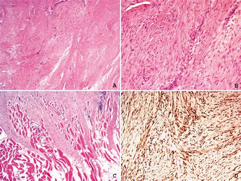 Soft Tissues: Desmoid-type fibromatosis | Soft, Tissue, Type