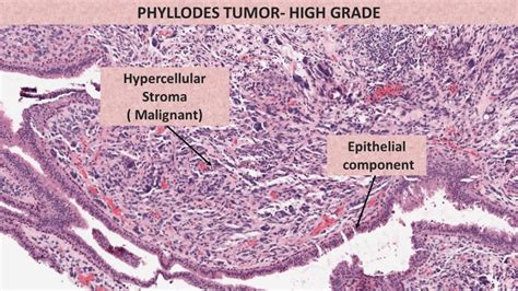 PHYLLODES TUMOR | Pathology Made Simple