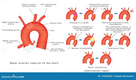 Coarctation Of The Aorta Repair